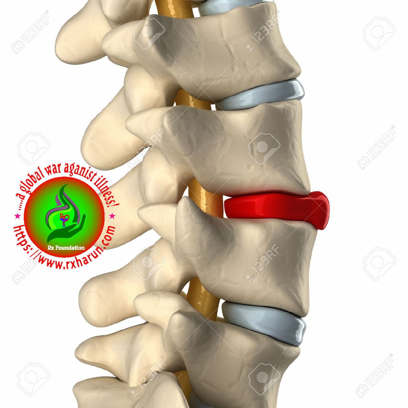 Grading/Types of Spondylolisthesis Causes Symptoms Grading/Types of Spondylolisthesis Causes Symptoms