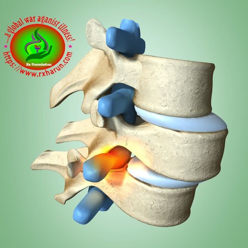 Grading/Types of Spondylolisthesis Causes Symptoms Grading/Types of Spondylolisthesis Causes Symptoms