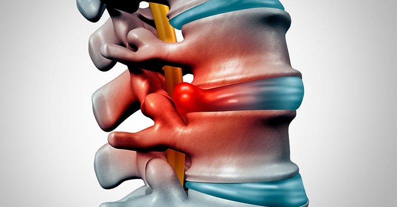 Treatment of Spinal Disc Herniation, Exercise, Home Remedies Treatment of Spinal Disc Herniation, Exercise, Home Remedies