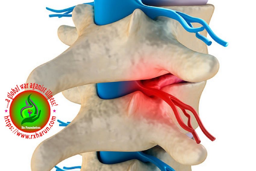 Grading/Types of Spondylolisthesis Causes Symptoms Grading/Types of Spondylolisthesis Causes Symptoms