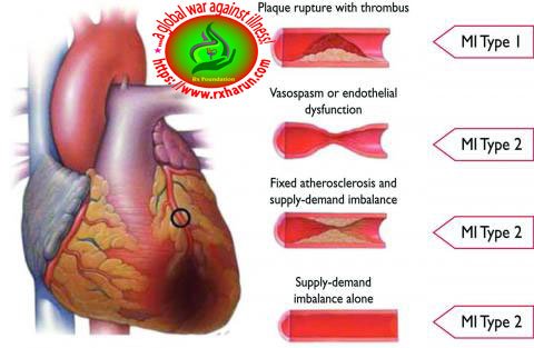 Treatment of Angina Pectoris, Prevention