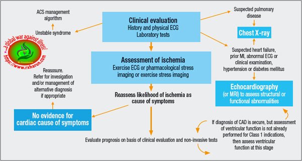 Variant Angina-Causes, Symptoms, Diagnosis, Treatment