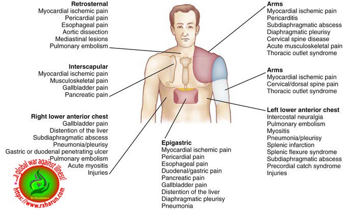 Variant Angina-Causes, Symptoms, Diagnosis, Treatment