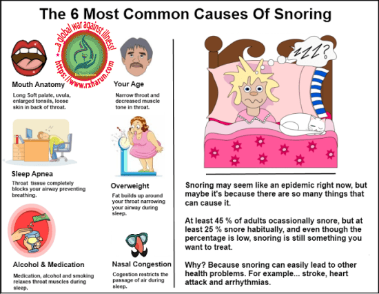 Obstructive Sleep Apnea; Symptoms, Diagnosis, Treatment