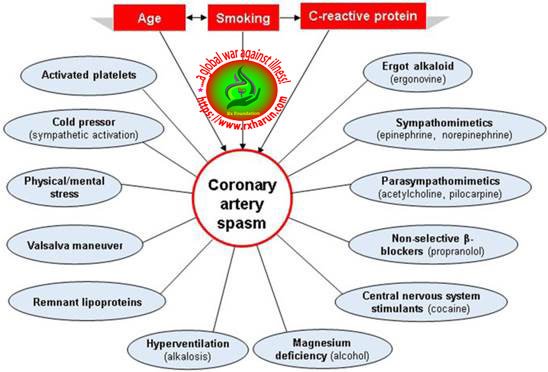 Variant Angina-Causes, Symptoms, Diagnosis, Treatment