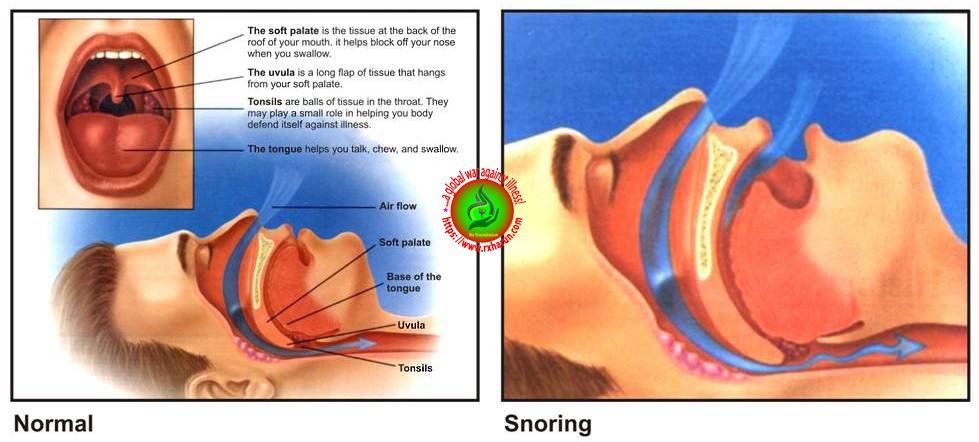 Obstructive Sleep Apnea; Symptoms, Diagnosis, Treatment
