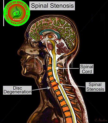 Degenerative Disk Disease; Symptom, Diagnosis, Treatment Degenerative Disk Disease; Symptom, Diagnosis, Treatment