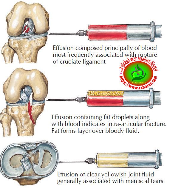 Joint Aspiration; Indications, Procedures, Risk Factors