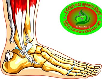 Achilles Tendon Rupture; Causes, Symptoms, Test, Treatment Achilles Tendon Rupture; Causes, Symptoms, Test, Treatment