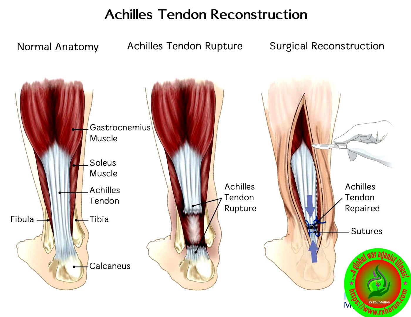 Achilles Tendon Rupture; Causes, Symptoms, Test, Treatment Achilles Tendon Rupture; Causes, Symptoms, Test, Treatment