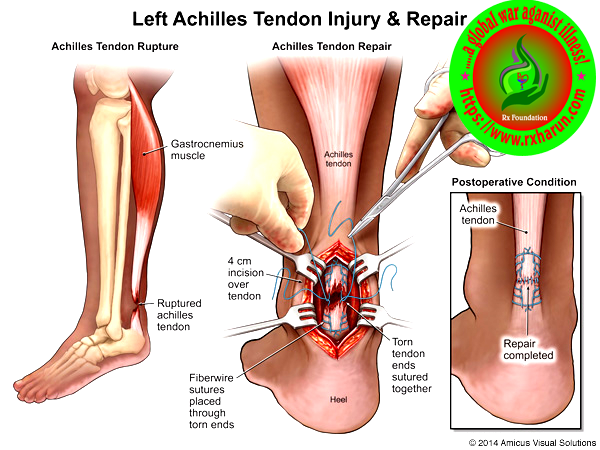 Achilles Tendon Rupture; Causes, Symptoms, Test, Treatment Achilles Tendon Rupture; Causes, Symptoms, Test, Treatment