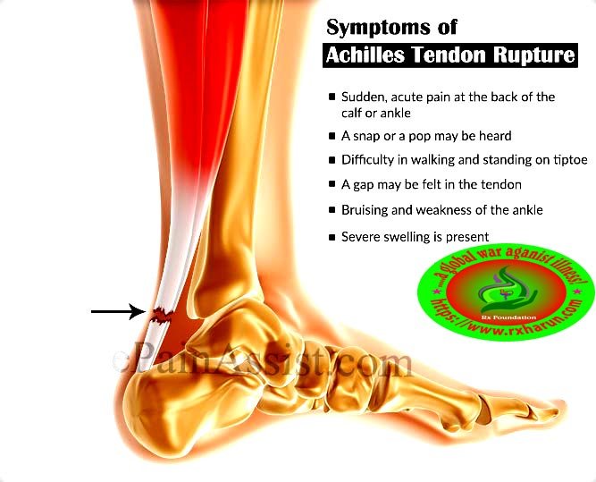 Achilles Tendon Rupture; Causes, Symptoms, Test, Treatment Achilles Tendon Rupture; Causes, Symptoms, Test, Treatment