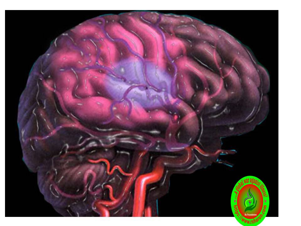 What happens to your body when you have a stroke?early Sign What happens to your body when you have a stroke?early Sign