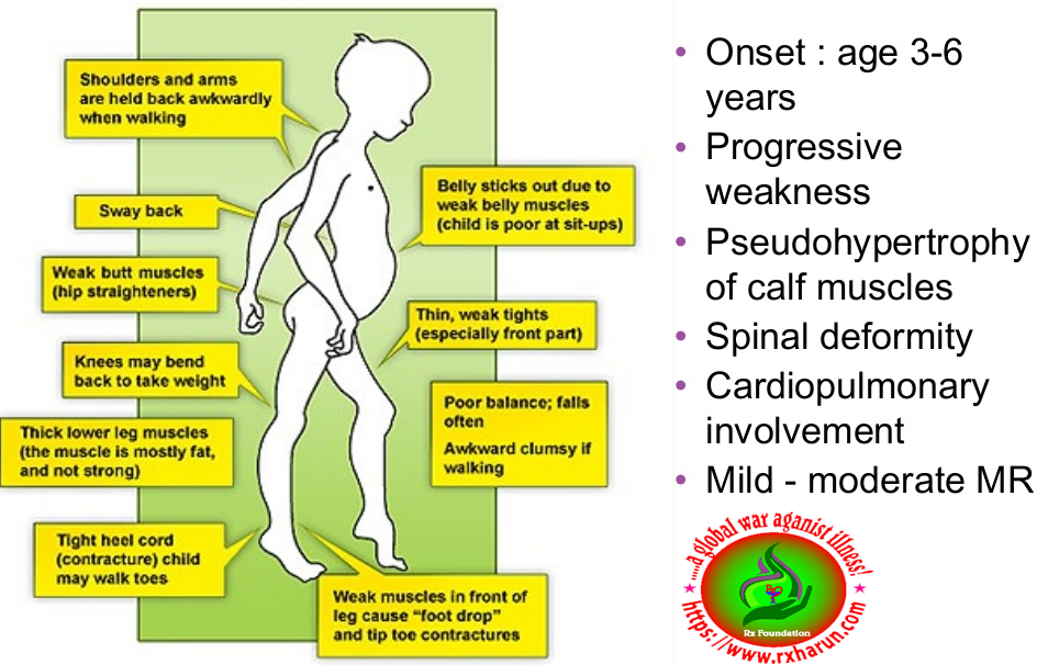 Duchenne Muscular Dystrophy - Causes, Symptoms, Treatment