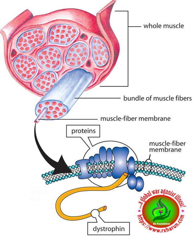 Duchenne Muscular Dystrophy - Causes, Symptoms, Treatment