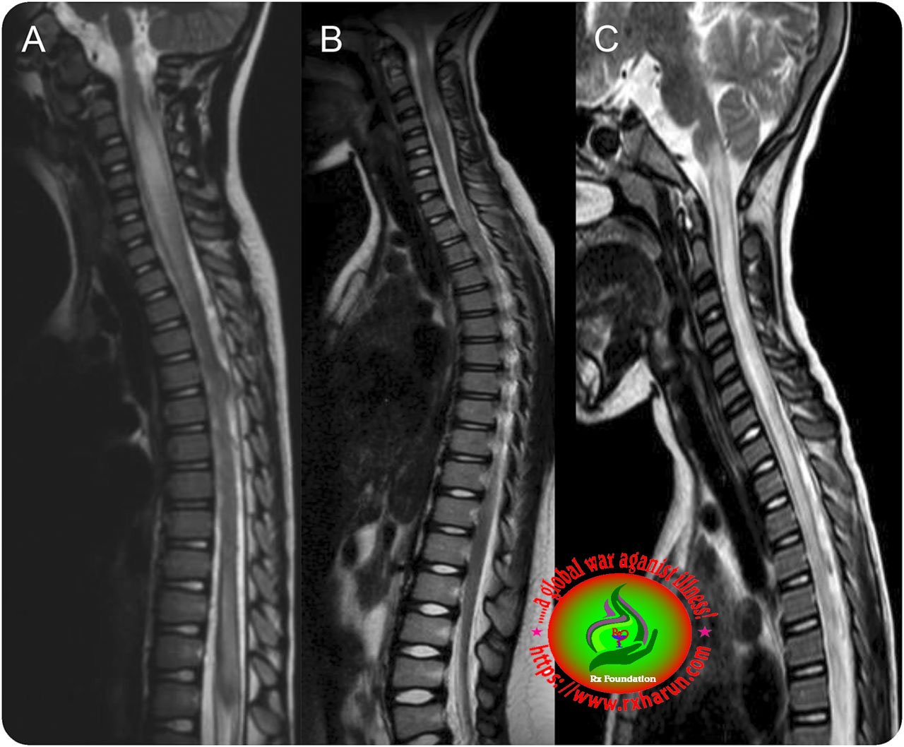 Transverse Myelitis - Causes, Symptoms, Diagnosis, Treatment Transverse Myelitis - Causes, Symptoms, Diagnosis, Treatment