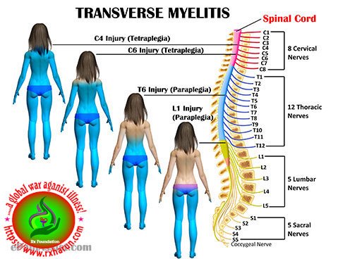 Transverse Myelitis - Causes, Symptoms, Diagnosis, Treatment Transverse Myelitis - Causes, Symptoms, Diagnosis, Treatment