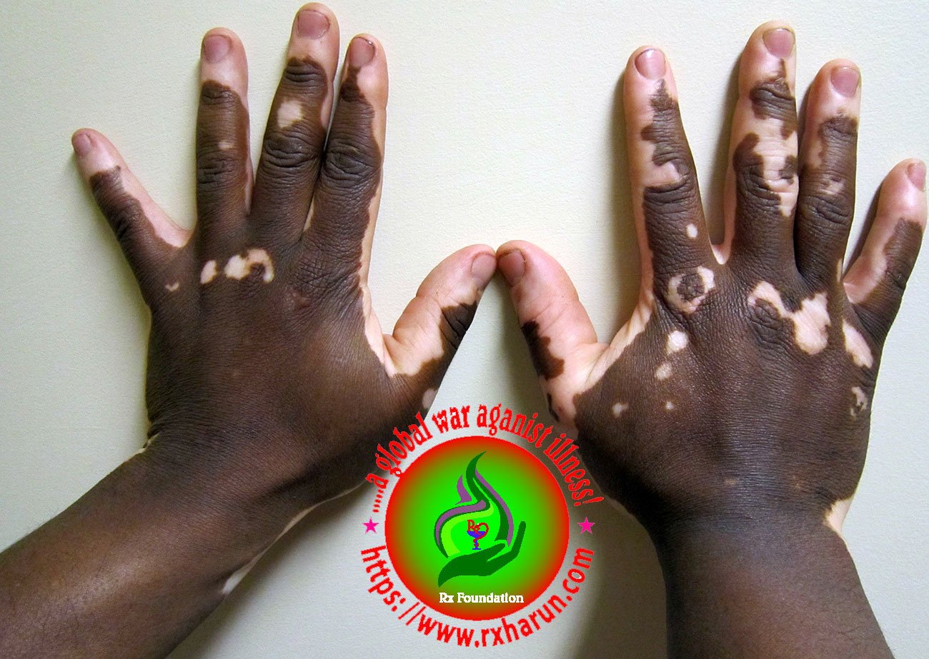 Skin Fading; Causes, Symptoms, Diagnosis, Treatment