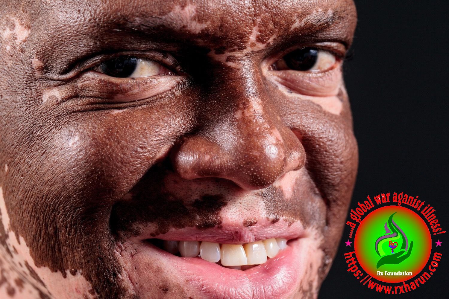 Skin Fading; Causes, Symptoms, Diagnosis, Treatment