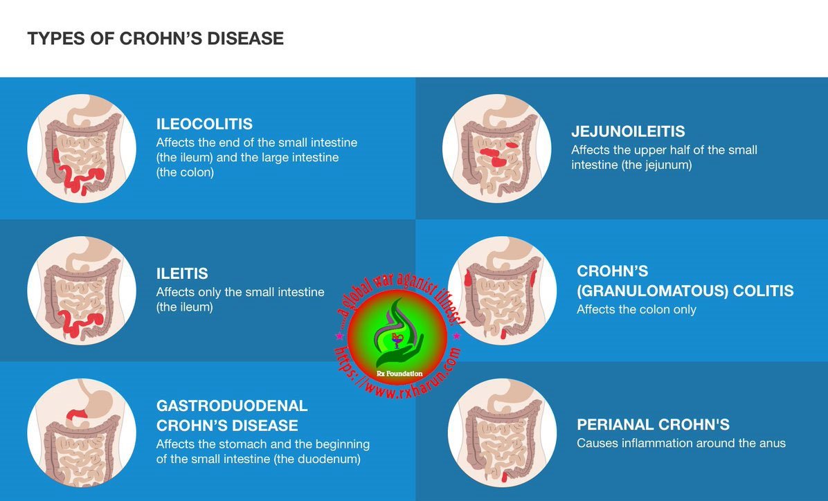 What Is Crohn's Disease and It First Signs Symptoms