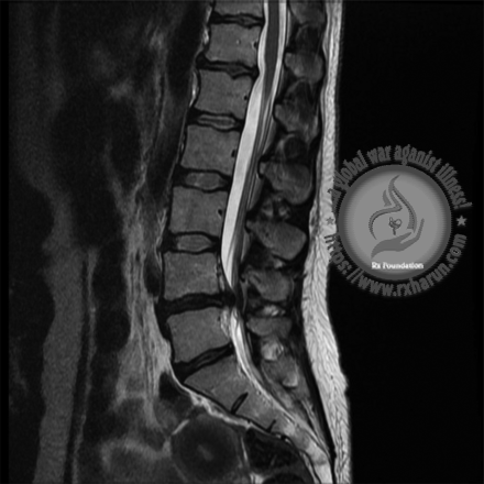 What Is PLID ? Symptoms, Diagnosis, Treatment