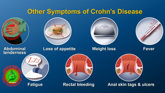 What Is Crohn's Disease and It First Signs Symptoms