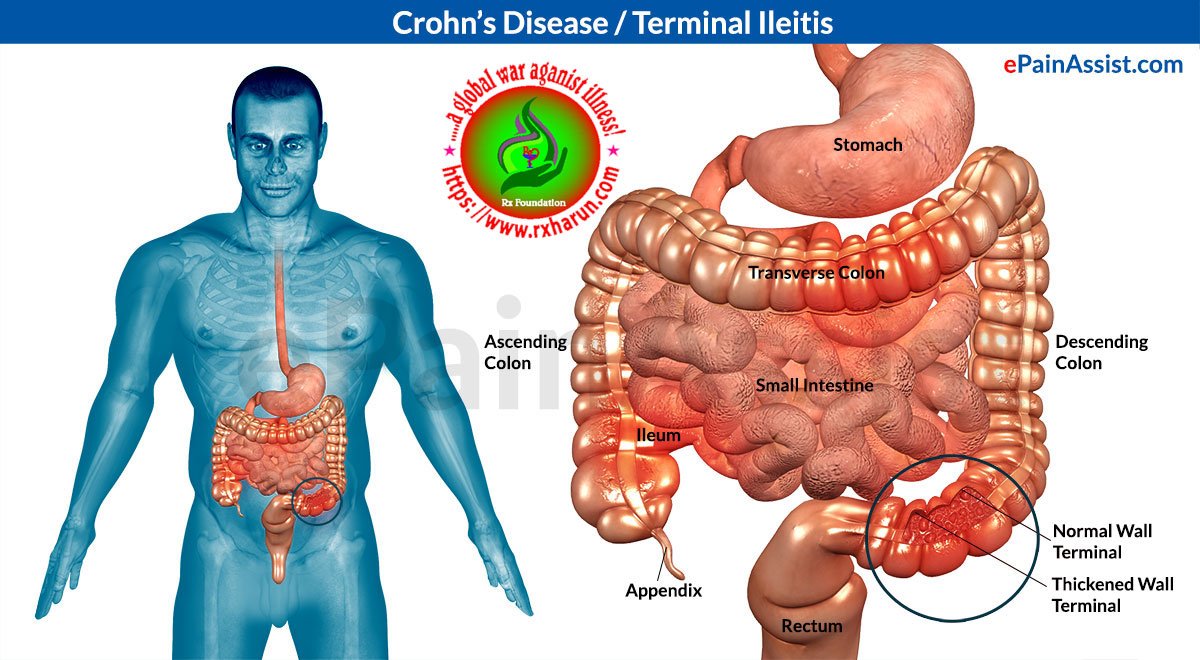 Crohn's Disease Diagnosis, Treatment, Prevention