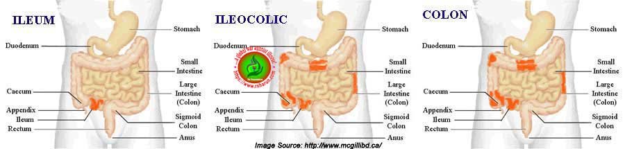 What Is Crohn's Disease and It First Signs Symptoms