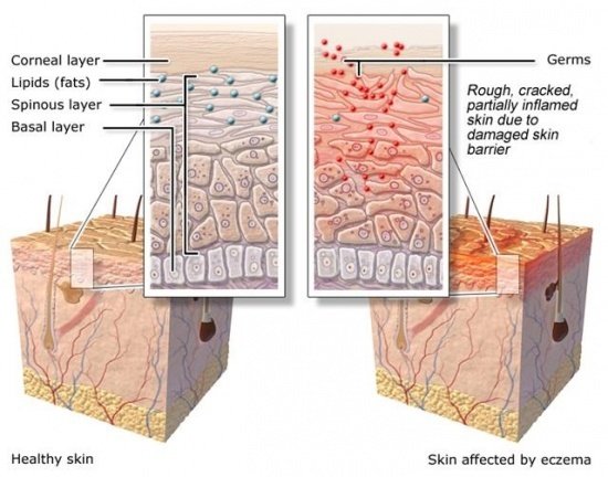 Eczema Treatment, Causes, Prevention