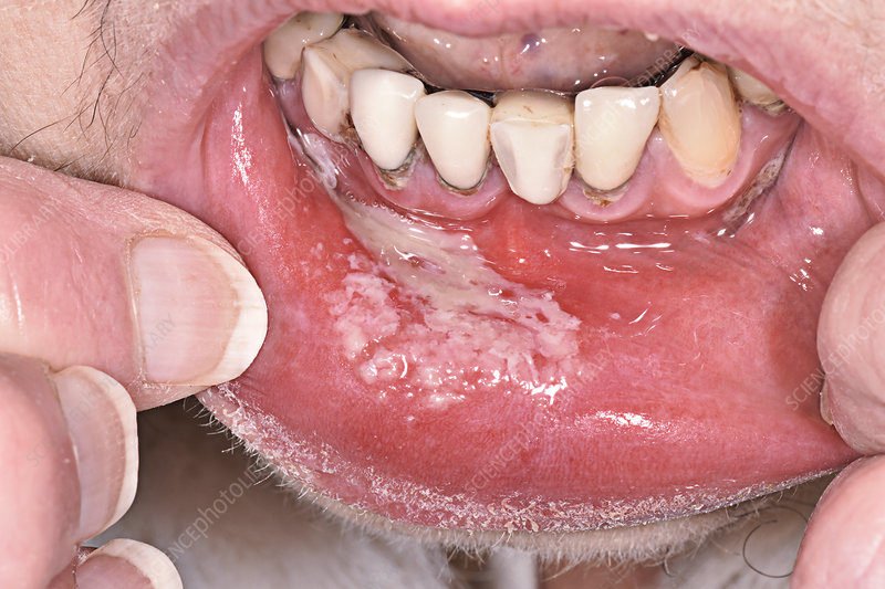 Candidiasis, Causes, Symptoms, Diagnosis, Treatment Candidiasis, Causes, Symptoms, Diagnosis, Treatment