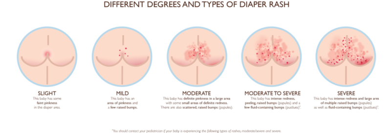 Napkin Dermatitis, Causes, Symptoms, Treatment