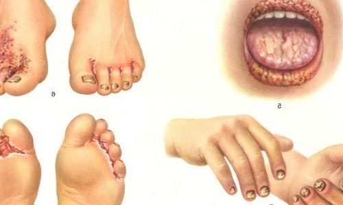 Candidiasis, Causes, Symptoms, Diagnosis, Treatment Candidiasis, Causes, Symptoms, Diagnosis, Treatment