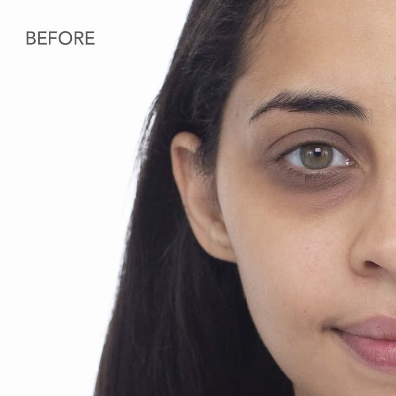 Black Color Under Eye Causes, Symptoms, Treatment