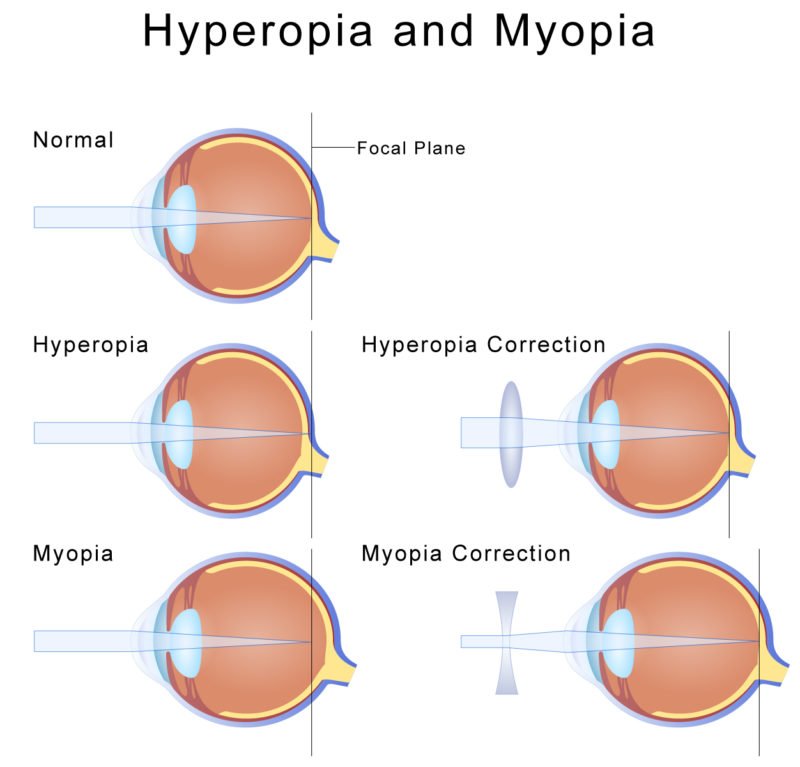 Hyperopia Symptoms, Diagnosis, Treatment Hyperopia Symptoms, Diagnosis, Treatment