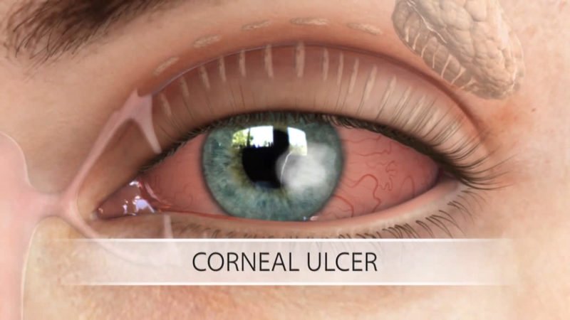 Corneal Ulcer Diagnosis, Treatment, Complication
