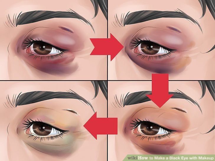Black Color Under Eye Causes, Symptoms, Treatment
