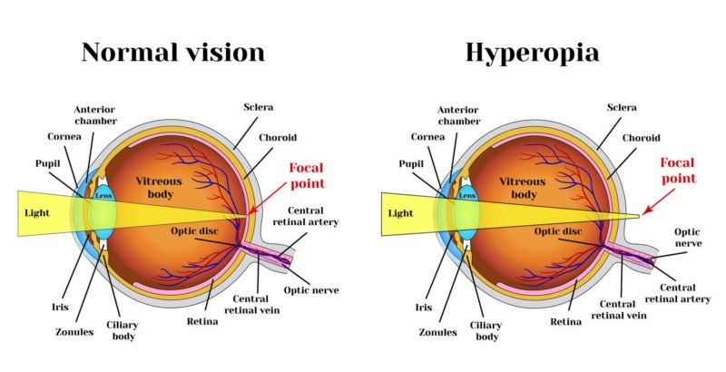 Hyperopia Symptoms, Diagnosis, Treatment Hyperopia Symptoms, Diagnosis, Treatment