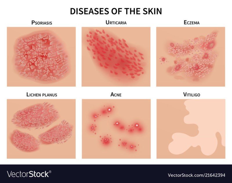 The Most Common Skin Problems, Home Remedies