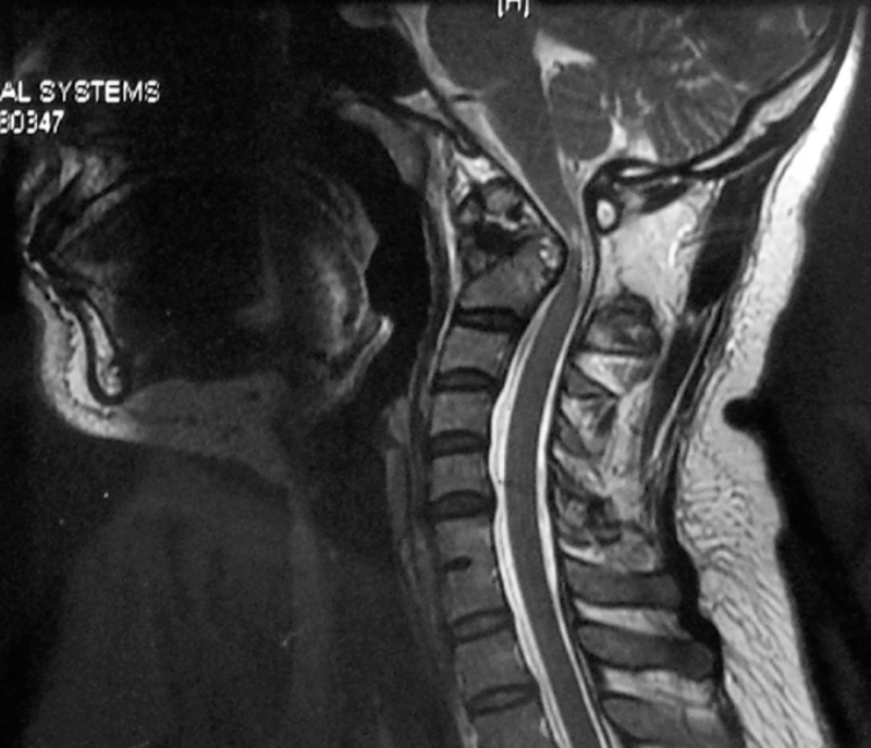 Treatment of Atlanto-occipital Dislocation