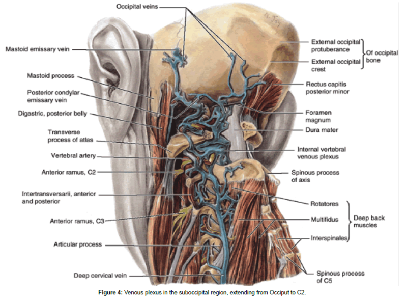 Treatment of Atlanto-occipital Dislocation