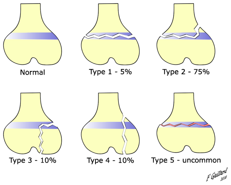Salter-Harris Type Fractures - Types, Symptoms, Treatment