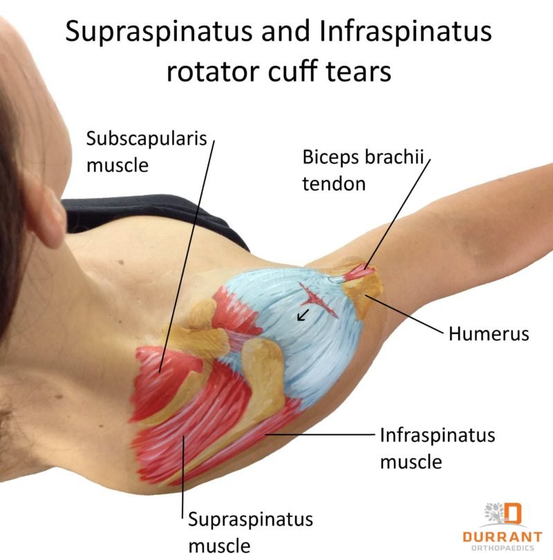 Muscles Attachment of Rotator Cuff Muscle