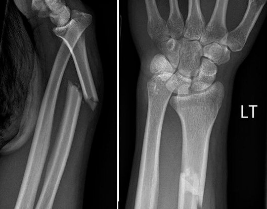 Common Forearm Fractures - Types, Classification