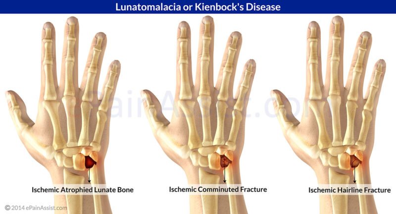 Avascular Necrosis of the Lunate - Symptoms, Treatment