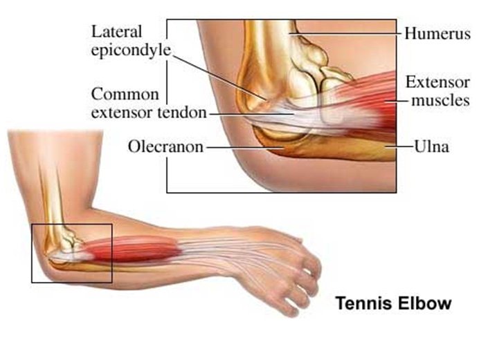 Elbow Joints Fractures - Causes, Symptoms, Treatment
