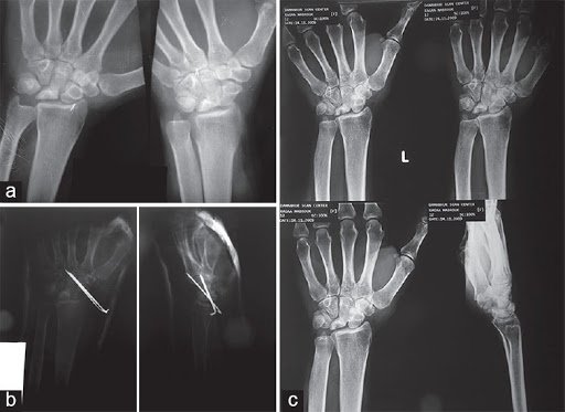 Avascular Necrosis of the Lunate - Symptoms, Treatment