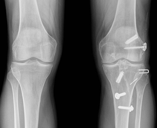 Knee Dislocation - Causes, Symptoms, Diagnosis, Treatment