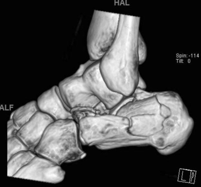 Lower Leg Muscle - Origin, Insertion, Nerve Supply, Function