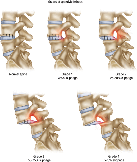 Pars Interarticularis Injury  - Causes, Symptoms, Treatment