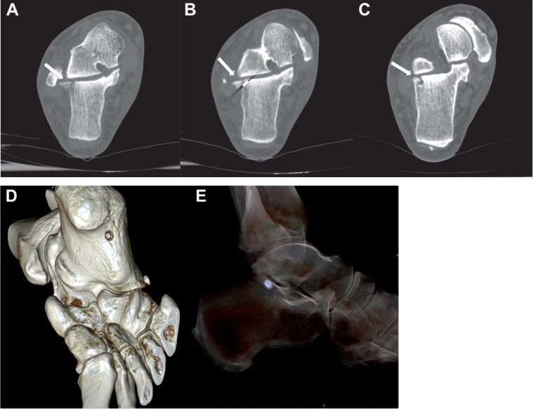 Calcaneus Fractures - Causes, Symptoms, Treatment